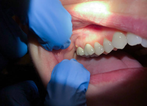 Best Urgent Tooth Repair  in Teague, TX