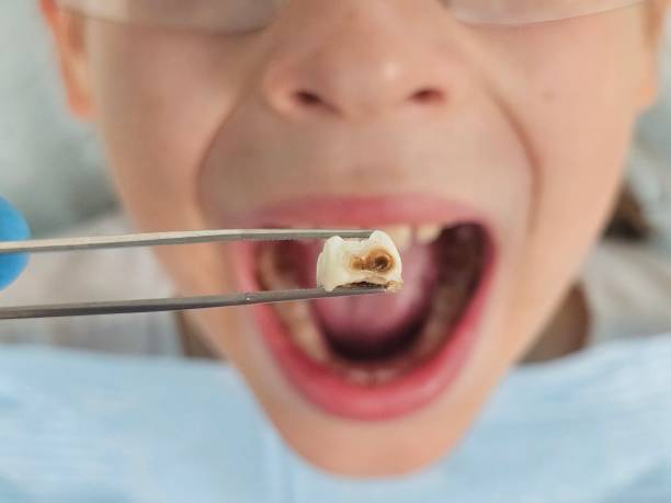 Best Root Canal Emergency Dentist  in Teague, TX